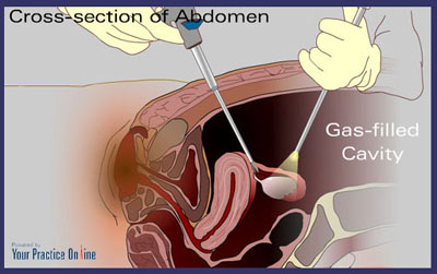 Laparoscopy